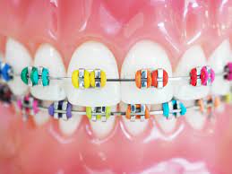 Colored Braces - Paseo Ranch Pediatric Dentistry & Orthodontics